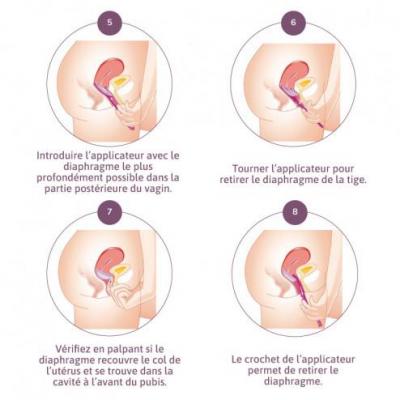 Applicateur pour introduction et retrait diaphragme 1